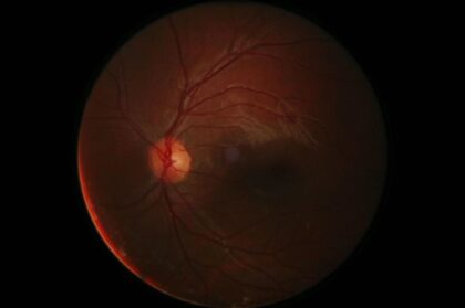 ¿Qué es el Glaucoma? un enemigo silencioso