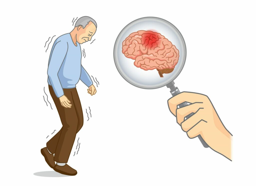El Parkinson se origina en el intestino