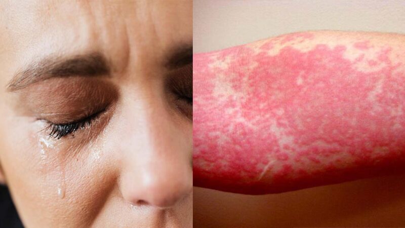 Alergia a tus lagrimas “urticaria Acuagénica”.
